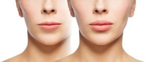 Lip Enhancement Enhanced Lips
