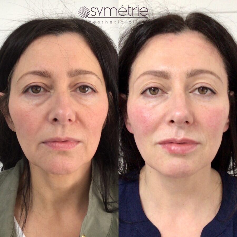 This 51 year old woman has had Botox, profhilo and dermal fillers to cheeks, midface, marrionette lines, jawline, chin and lips