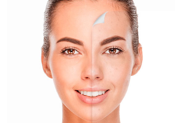 Skin Peel 4 Nav