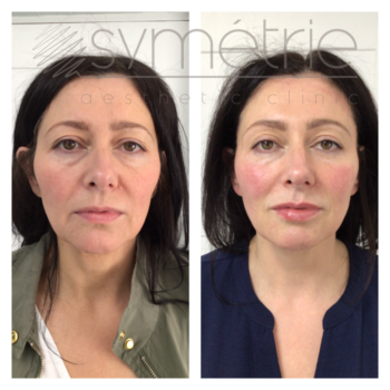 Dermal Fillers Before and After