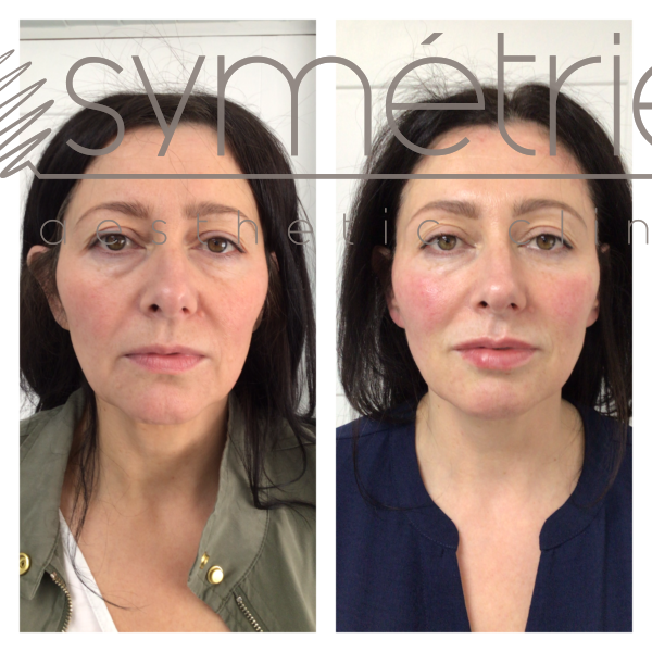 Dermal Fillers Before and After