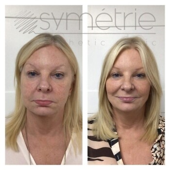 Dermal Fillers Before and After