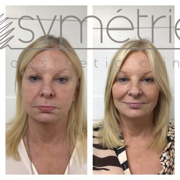 Dermal Fillers Before and After