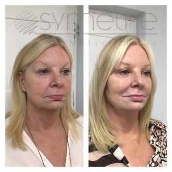 Dermal Fillers Before and After