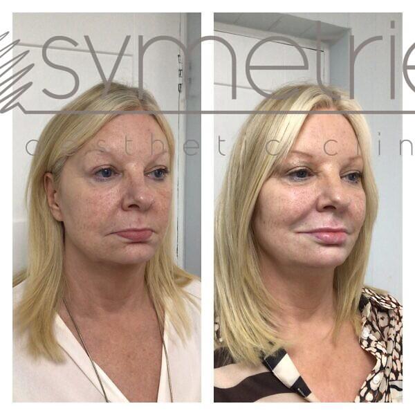 Dermal Fillers Before and After