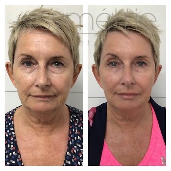 8 Point Face Lift Before and After