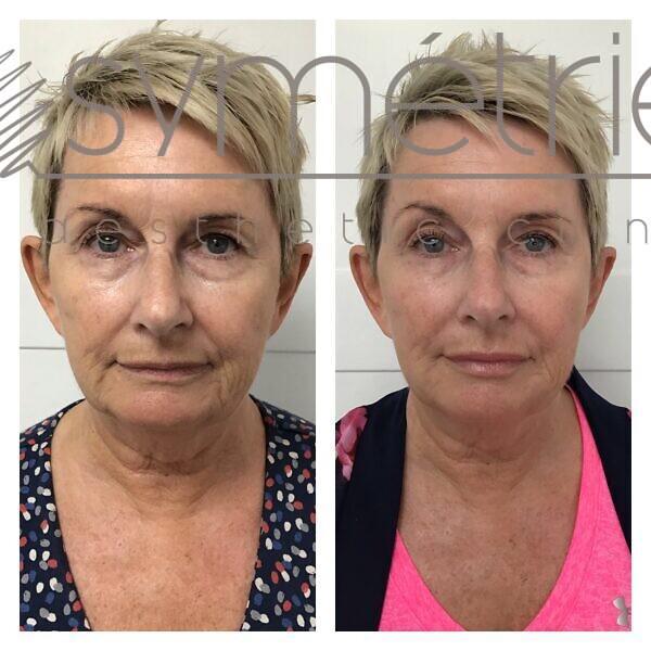 8 Point Face Lift Before and After