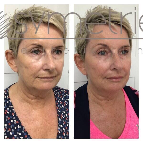8 Point Face Lift Before and After