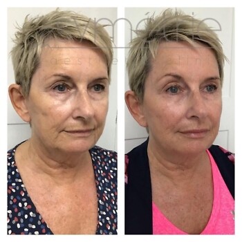 Dermal Fillers Before and After