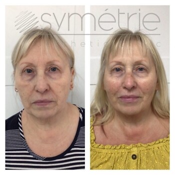 Dermal Fillers Before and After
