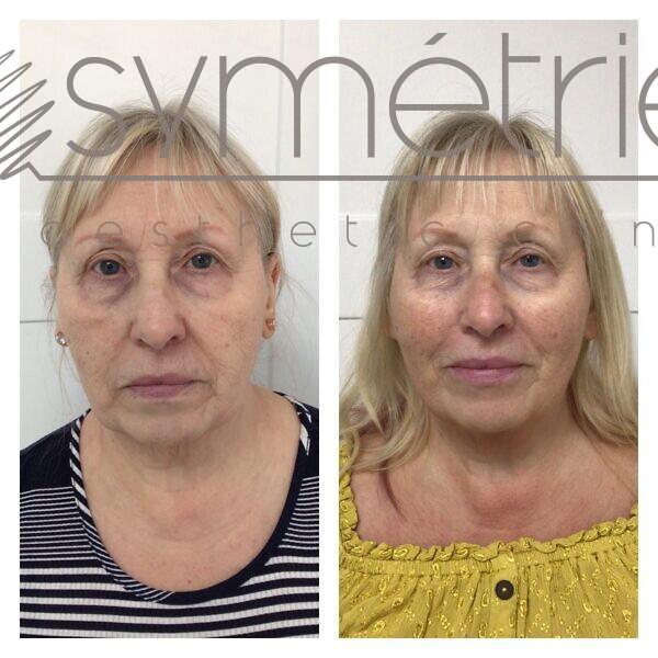 Dermal Fillers Before and After