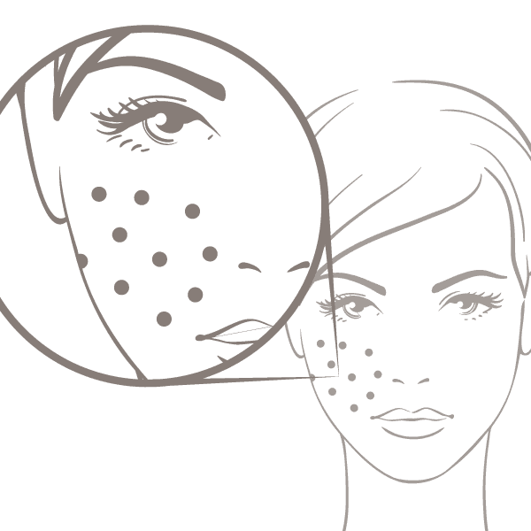 Symetrie Acne - Acne Scarring