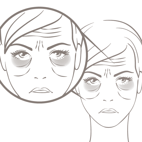 Symetrie Loss of Facial Volume