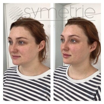 Lip Enhancement Before and After