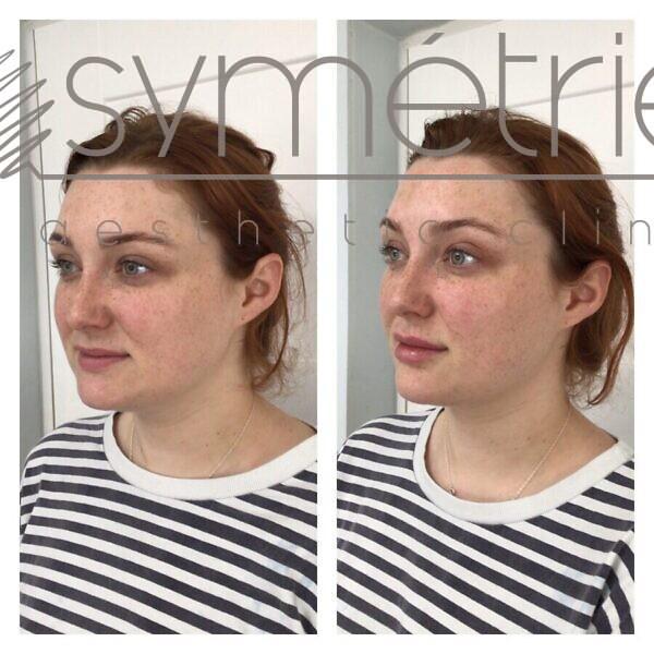 Lip Enhancement Before and After