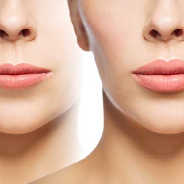 Lip Enhancement Symétrie Aesthetic Clinic Oldswinford Stourbridge