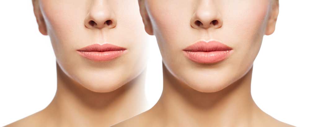 Lip Enhancement Symétrie Aesthetic Clinic Oldswinford Stourbridge