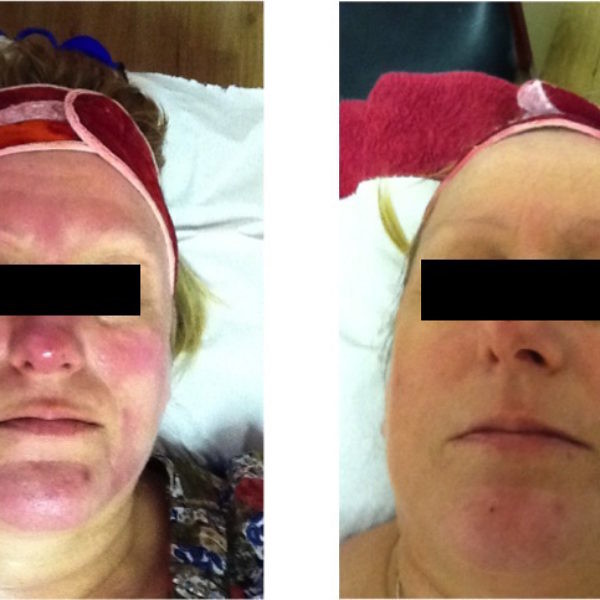 Dermalux award winning LED light therapy at Symétrie in Stourbridge