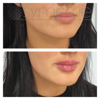 Lip Enhancement Before and After