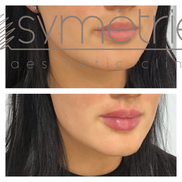 Lip Enhancement Before and After