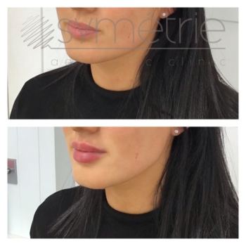Lip Enhancement Before and After