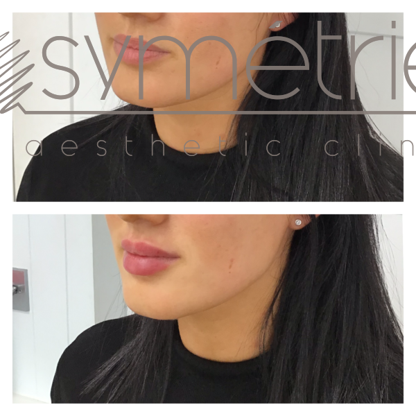 Lip Enhancement Before and After