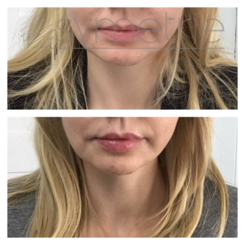 Lip Enhancement Before and After
