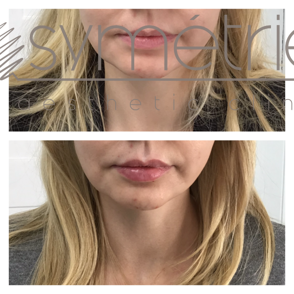 Lip Enhancement Before and After