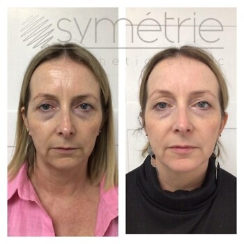 Profhilo Before and after