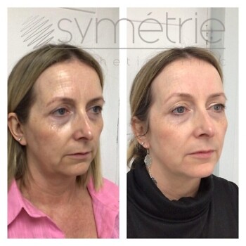 Profhilo Before and after