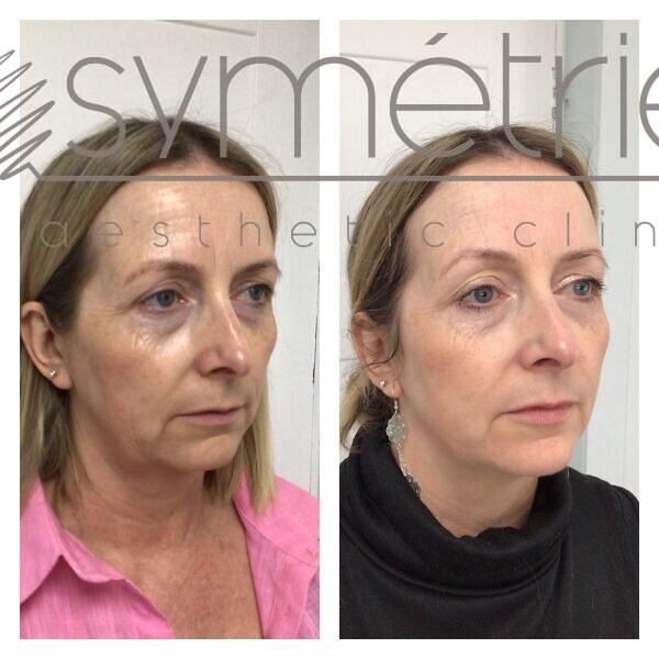 Profhilo Before and after