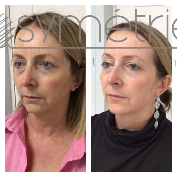 Profhilo Before and after