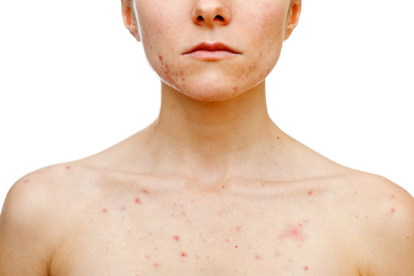 Acne Body Dermalux Treatment at Symétrie Aesthetic clinic Oldswinford Stourbridge