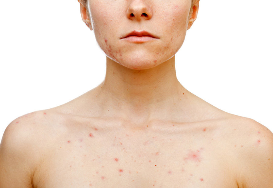 Acne Body Dermalux Treatment at Symétrie Aesthetic clinic Oldswinford Stourbridge