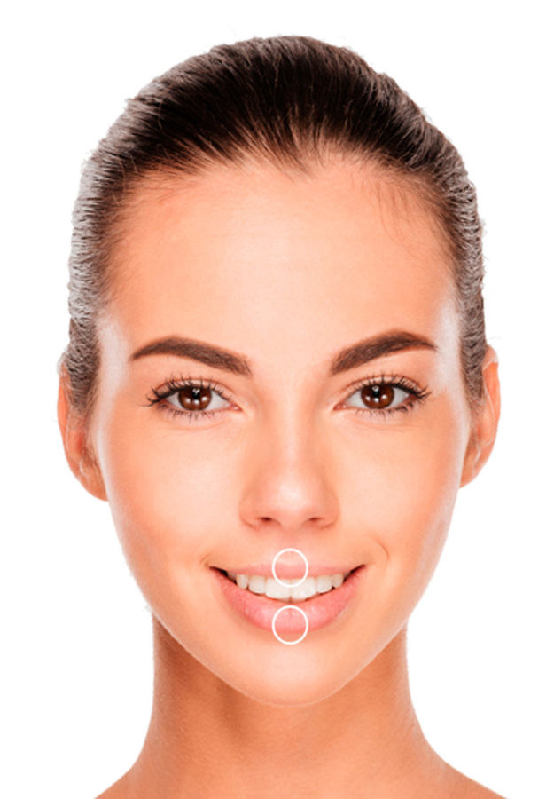 Lip Enhancement Dermal Fillers Symetrie Stourbridge