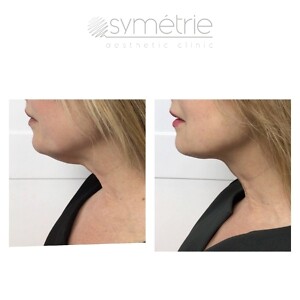 Celluform Before & After