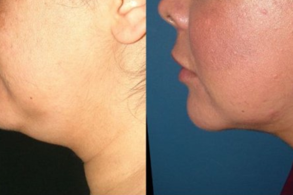 Before And After 1 Session 40 Days