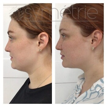 Celluform Before & After