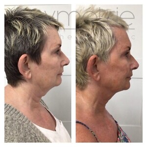 Celluform Before & After