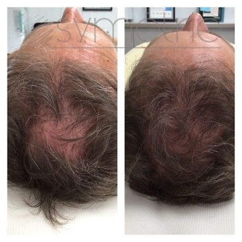 XL Hair Before and After