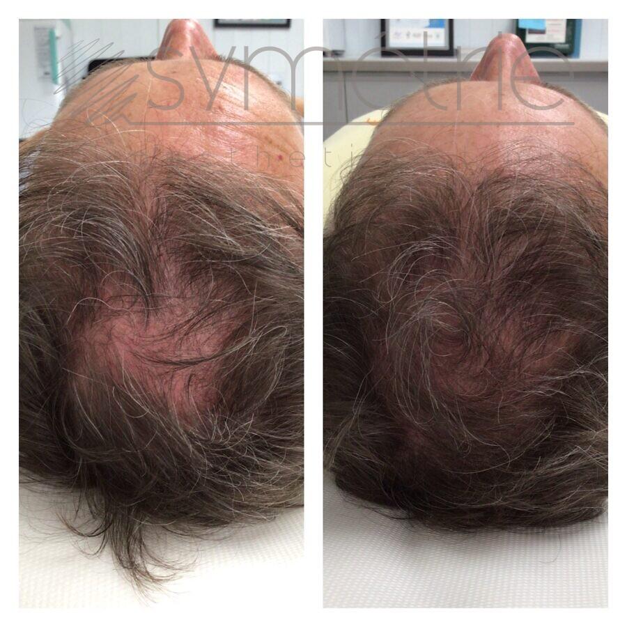 Hair Loss - Male and Female pattern baldness and Alopecia Treatment
