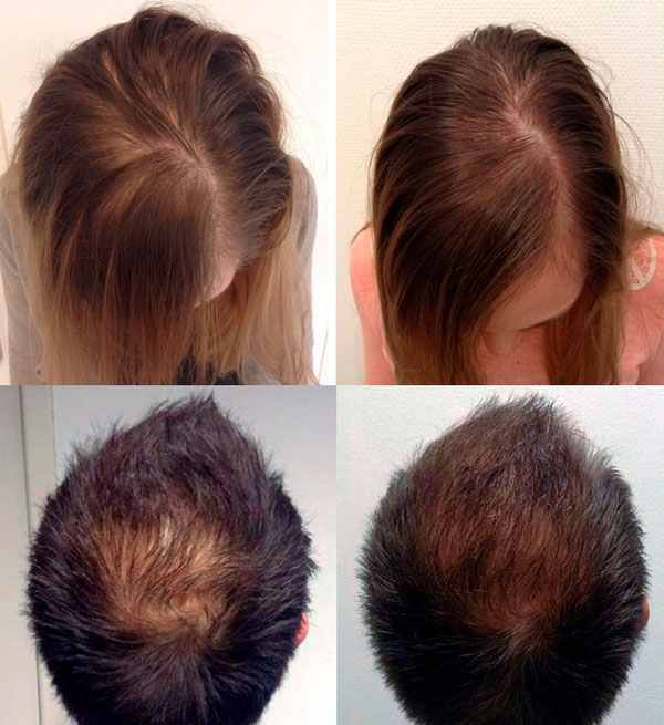 Hair Loss - XL Hair a revolutionary new treatment against Hair loss